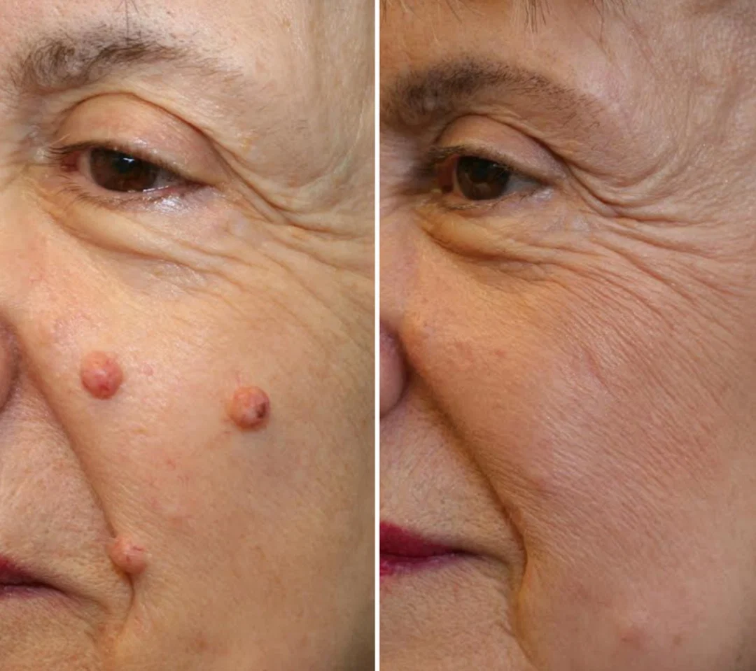 CryoClear Pro Bump Renewal Spray