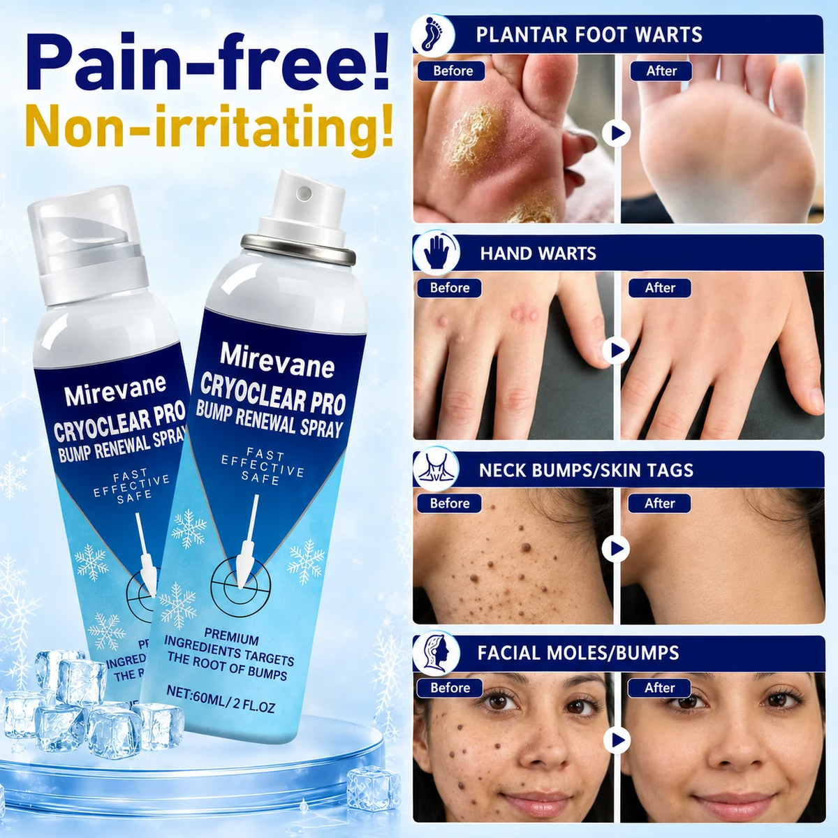 CryoClear Pro Bump Renewal Spray