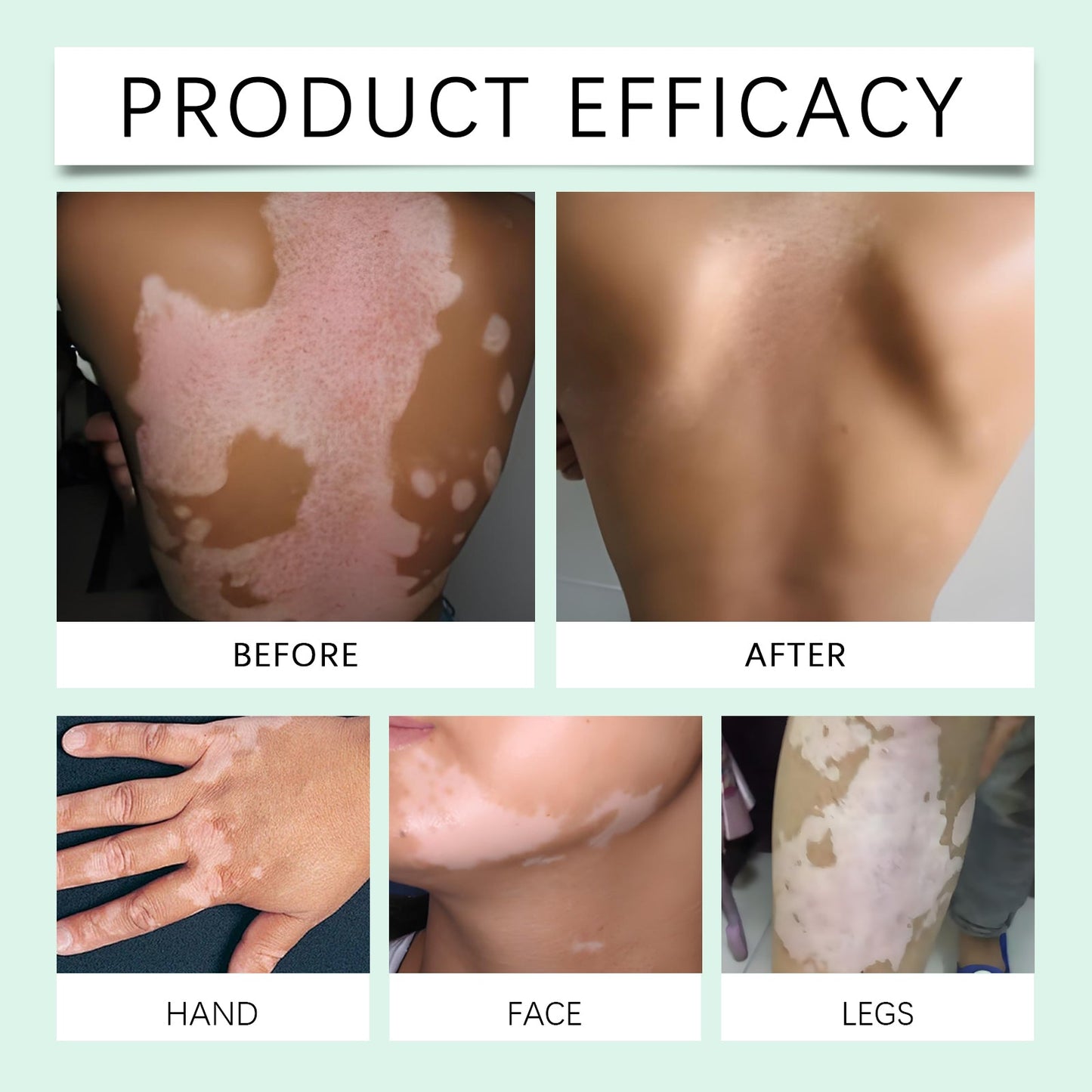 Vitiligo Herbal Aloe Vera & Mint Care Cream