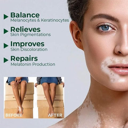 Vitiligo Herbal Aloe Vera & Mint Care Cream