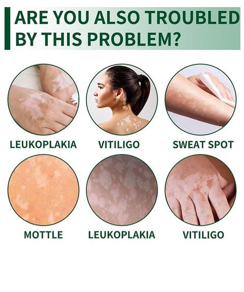 Vitiligo Herbal Aloe Vera & Mint Care Cream