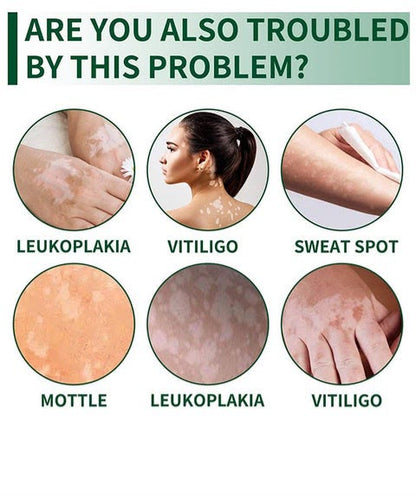 Vitiligo Herbal Aloe Vera & Mint Care Cream