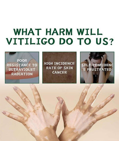 Vitiligo Herbal Aloe Vera & Mint Care Cream